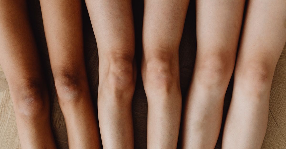 Lekkie nogi na lata: 9 sprawdzonych sposobów, by nie dać się żylakom